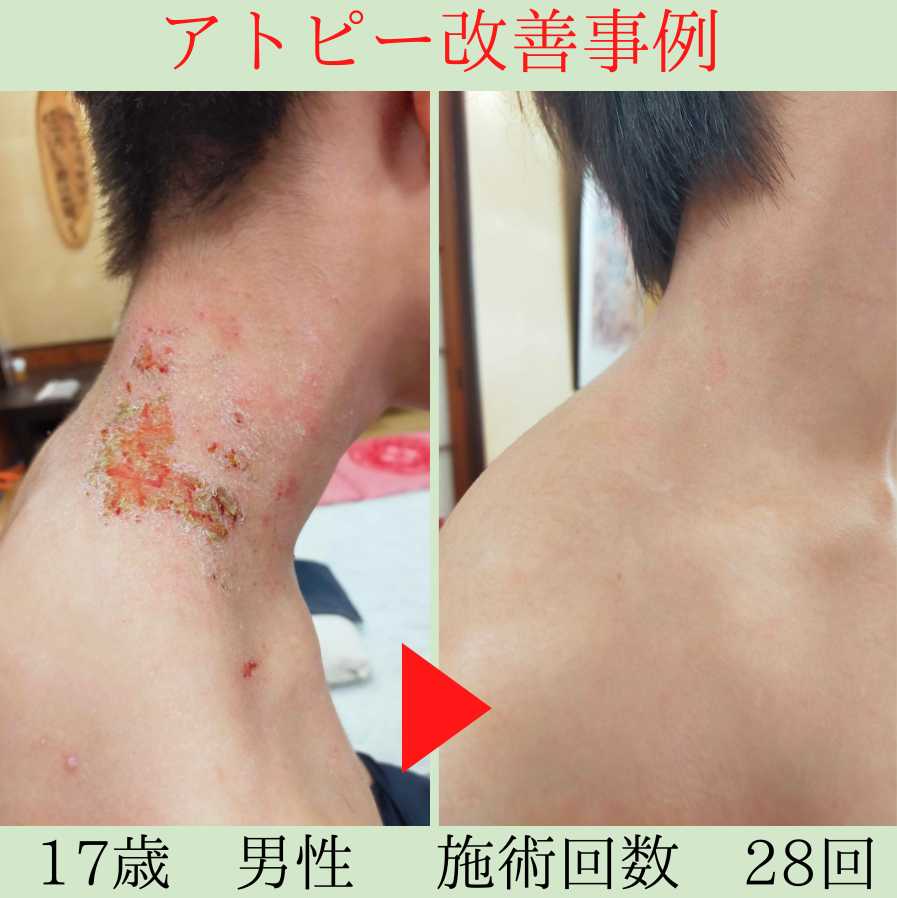 幼少期からのアトピーを克服｜薬を手放し「自分の力」で改善できました。　袋井市　17歳　H君