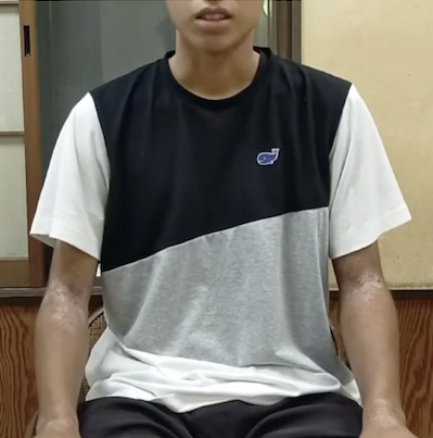 指先のアトピーが改善!家族と取り組むセルフケアで早期回復へ 浜松市 21歳 Mさん